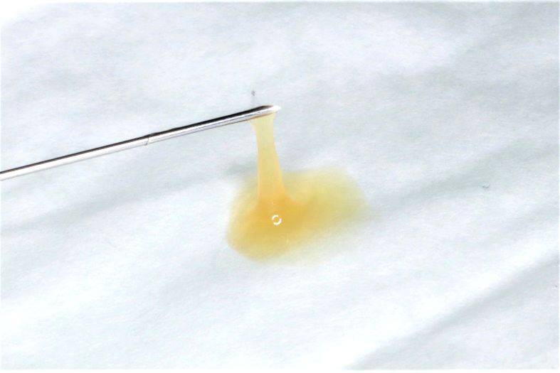 孩子舌头下长了个小肉团,原来是ta