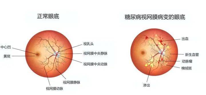 教你如何看懂眼底检查