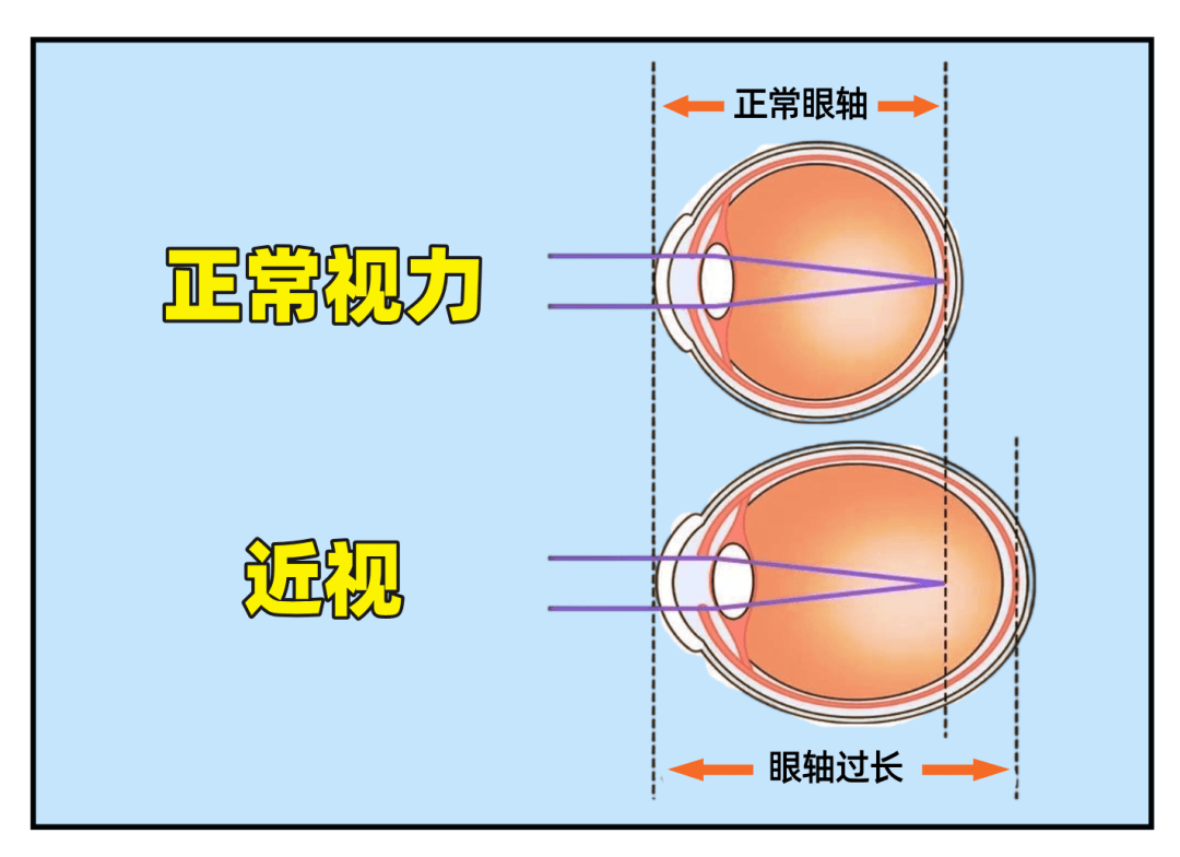 近视眼与正常眼睛外观图片