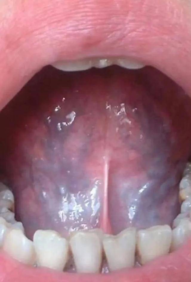 如果发现舌头底下有淤络,务必重视。_淤血_血液_癌症
