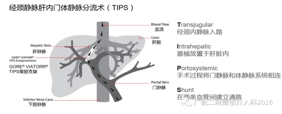 微创tips治疗技术（经颈静脉肝内门体分流术）的应用，不仅减少了患者的创