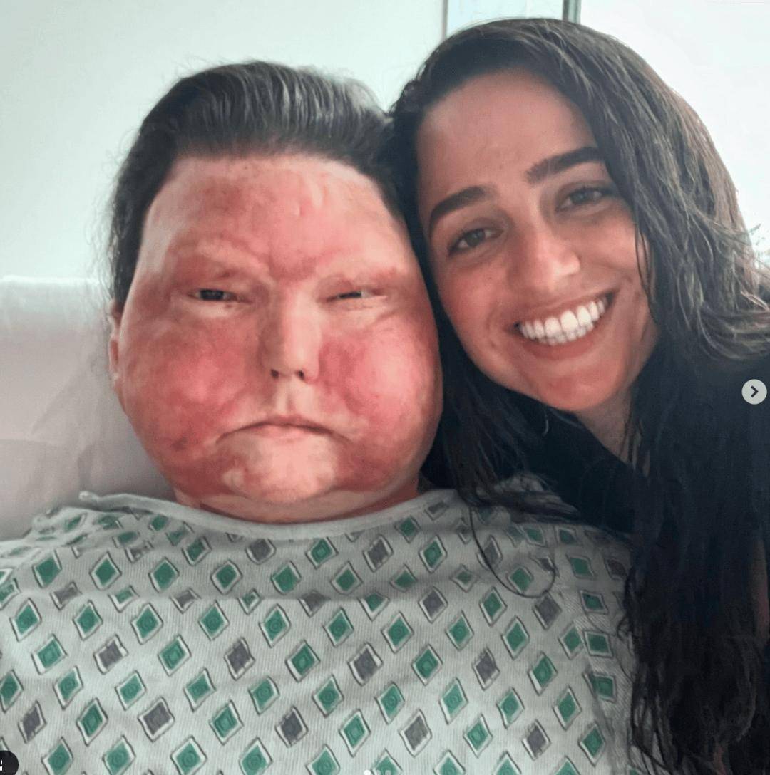 男子意外毁容,接受首例脸部移植判若两人,还意外收获爱情