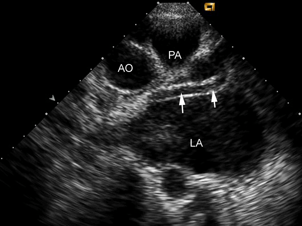 一文掌握:超声心动图必备基本功