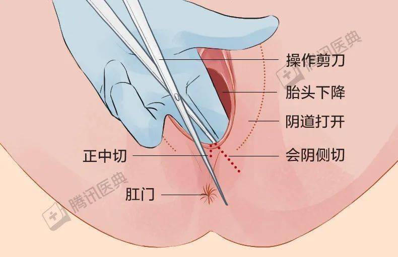 侧切图片真实图片