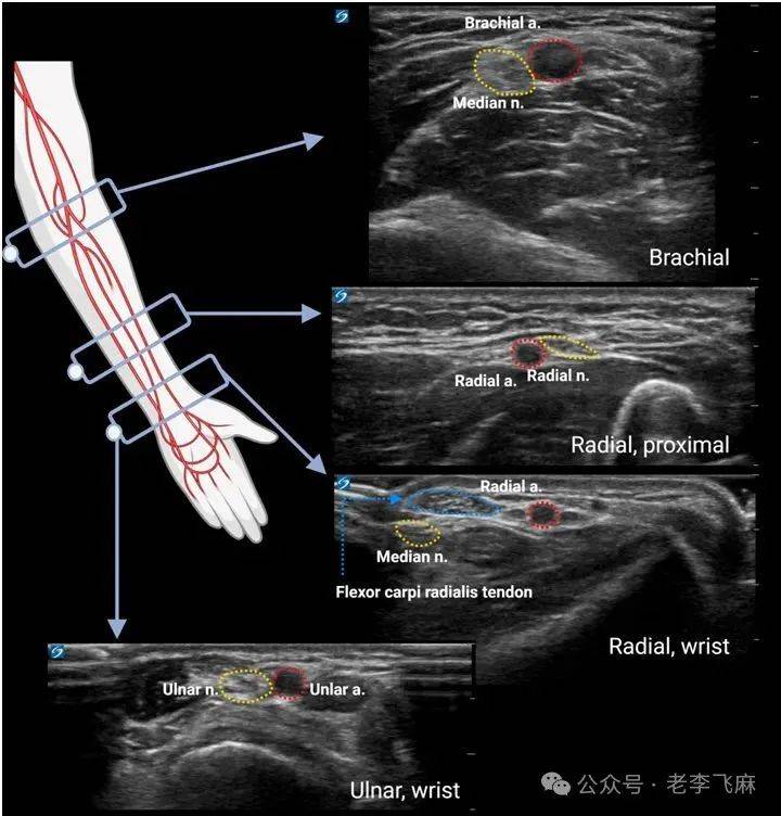 brachial artery图片