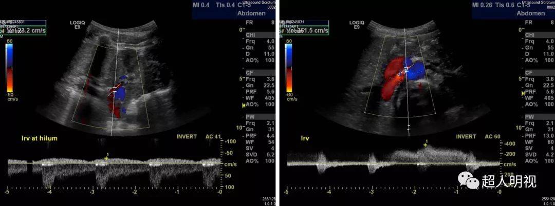 胡桃夹综合征超声诊断图片