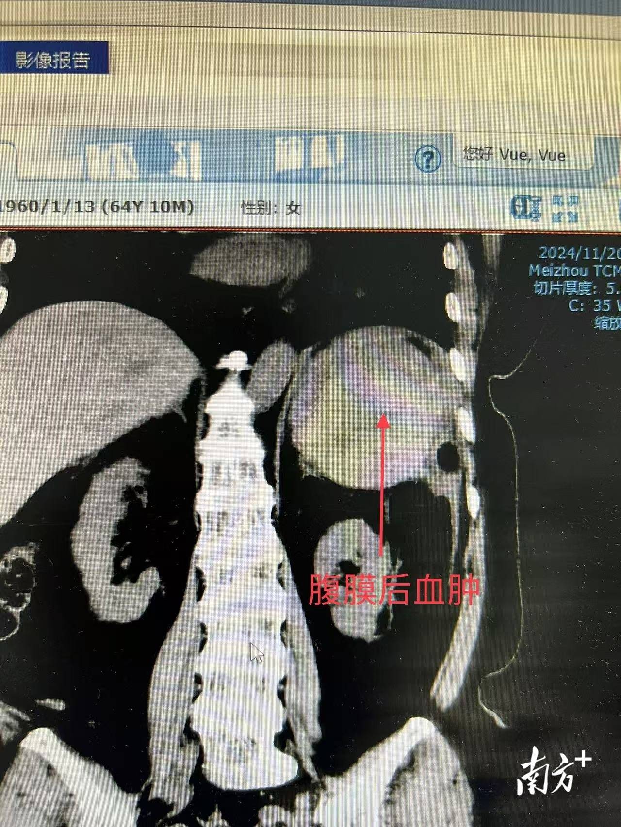 情况紧急！广州中医药大学梅州医院医务人员通力合作成功救治一马来西亚华侨