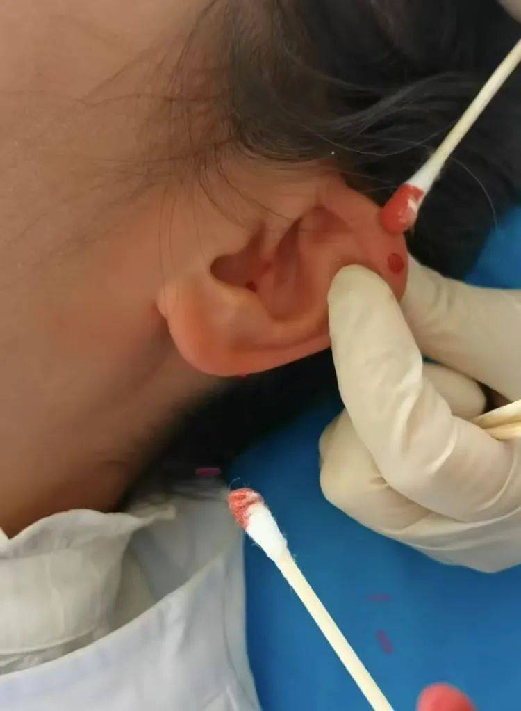 小小耳部刮痧治顽疾,长期失眠的李姐笑了