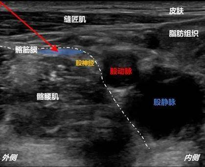 髂筋膜间隙阻滞图片