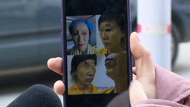 青岛西海岸新区:花际医美18万打除皱针 脸颊凹陷出“大坑”(图4)