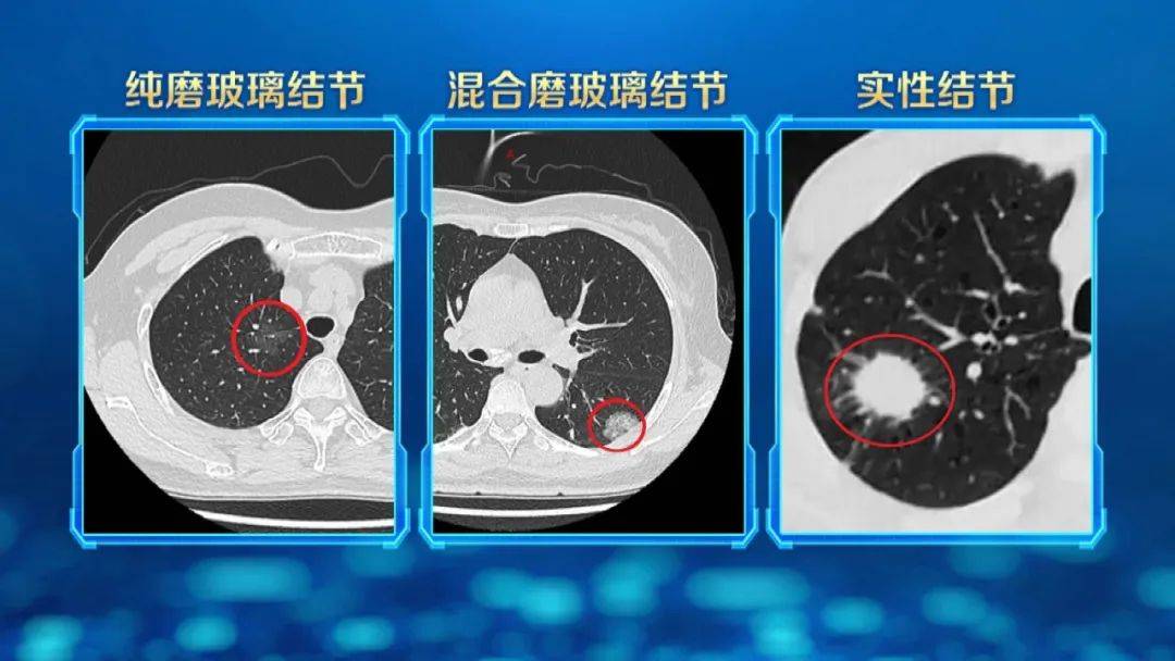 【养生堂】今日17:25播出《破译肺结节的"癌变"密码》