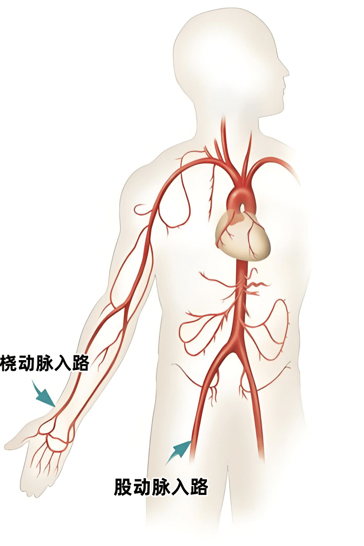 动脉造影的两条入路:股动脉与桡动脉江锋介绍,"这种技术通过细小的桡
