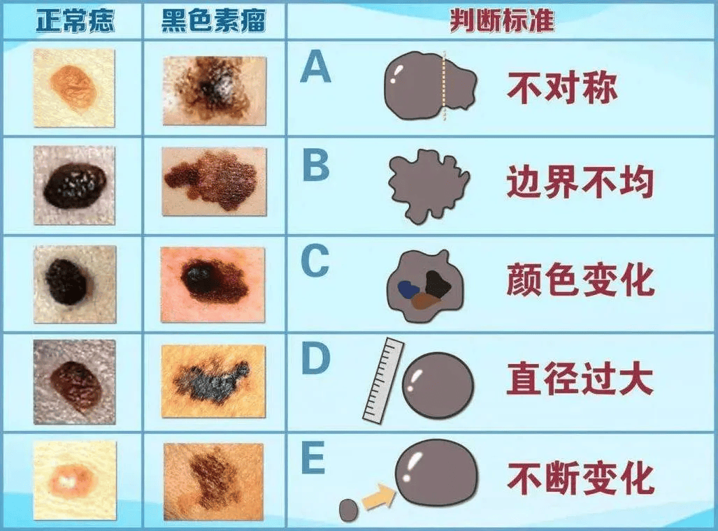 对于恶性程度高的黑色素瘤,早期发现并治疗,生存率可达
