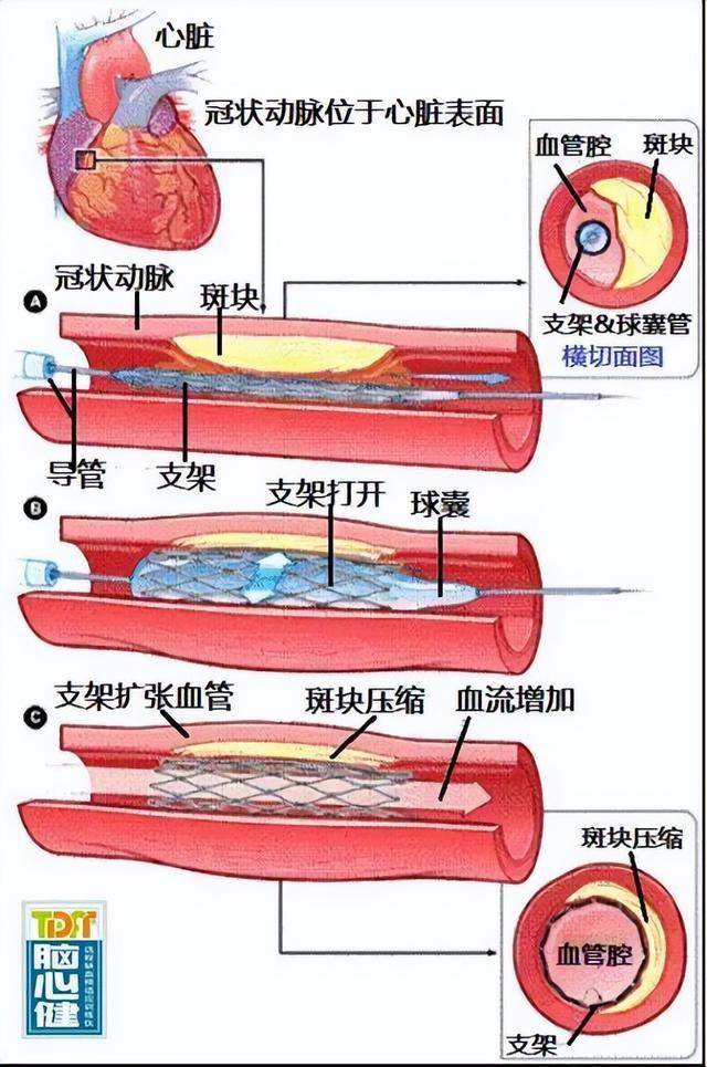 心脏支架位置图片