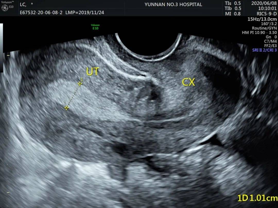 超声检查评估是目前评估子宫内膜容受性的最常用方法,具有安全性,无创