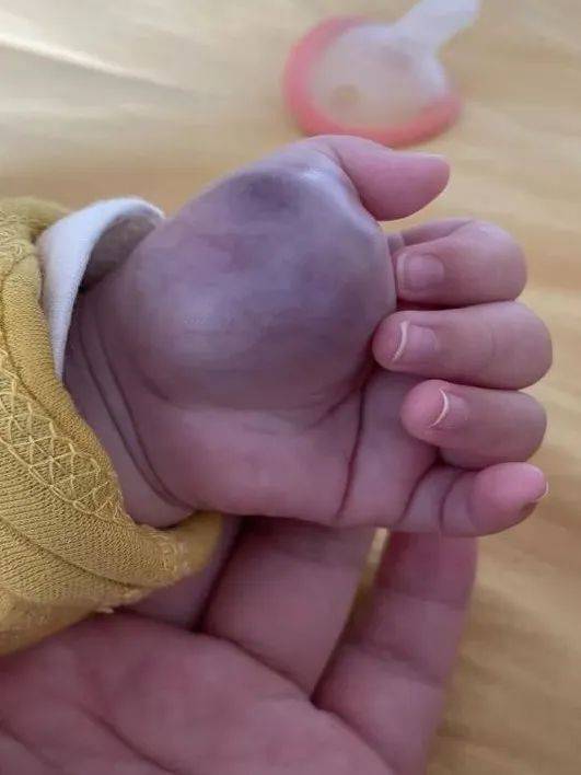 婴儿手掌长出了罕见巨瘤,上海儿童医学中心张江院区精准施治,小手恢复