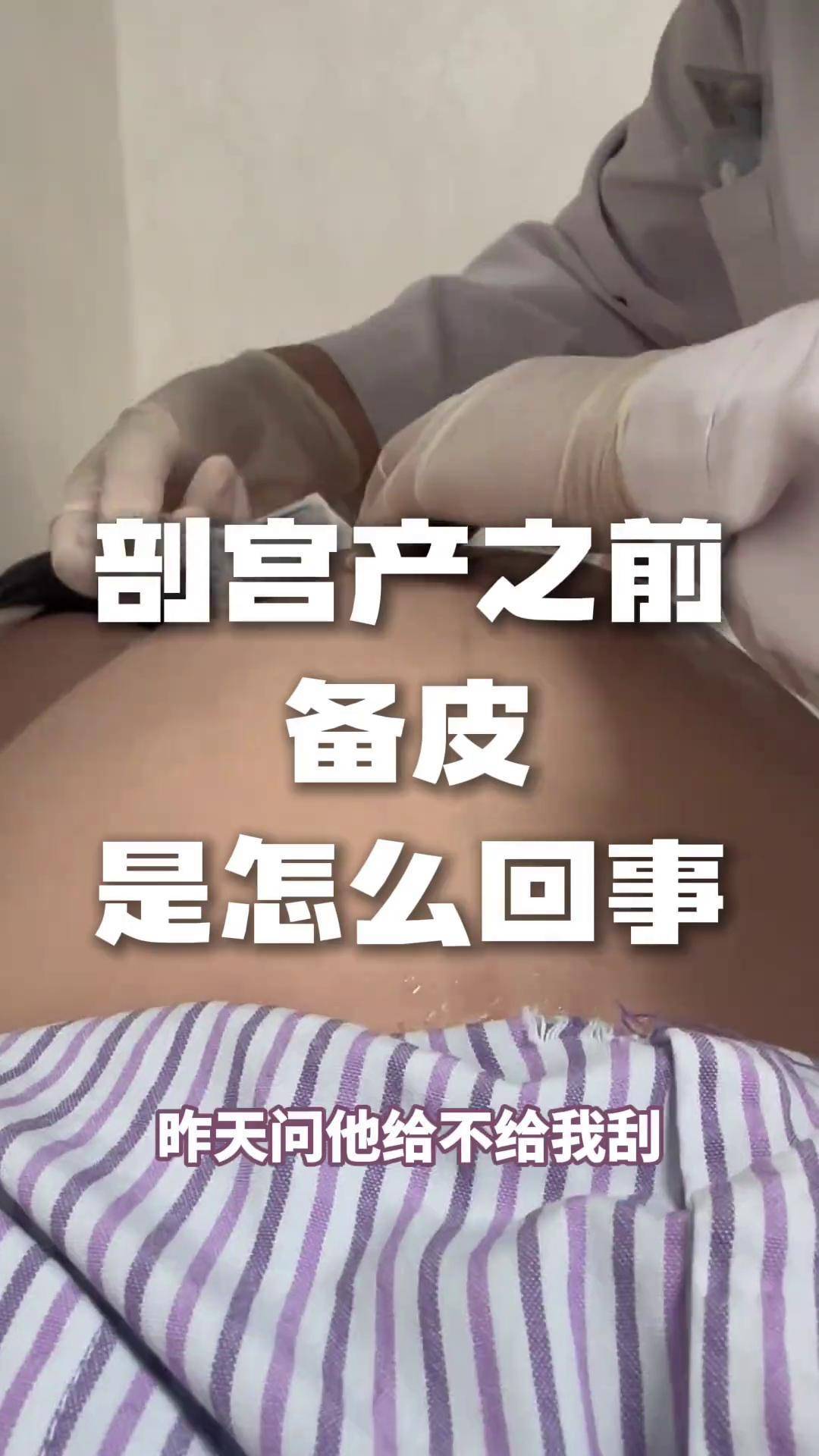 剖宫产之前都要做的备皮,是怎么回事?