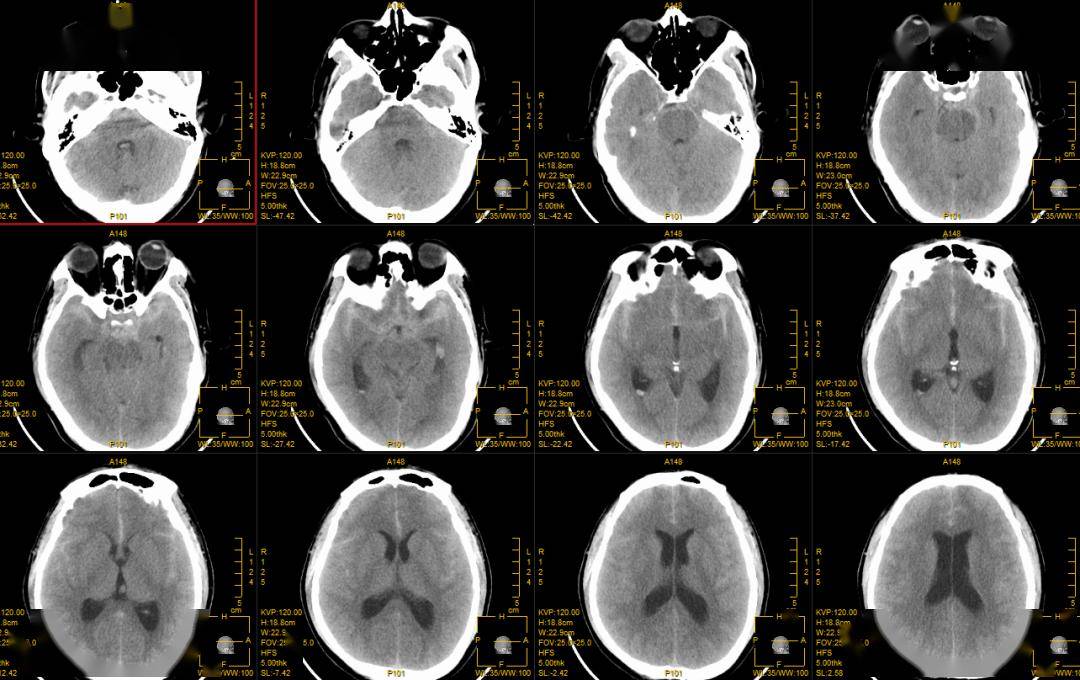 唐景峰教授专栏:瘤内扰流装置治疗颅内动脉瘤病例合集
