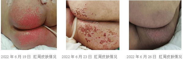 失禁性皮炎这样护理,效果立竿见影!