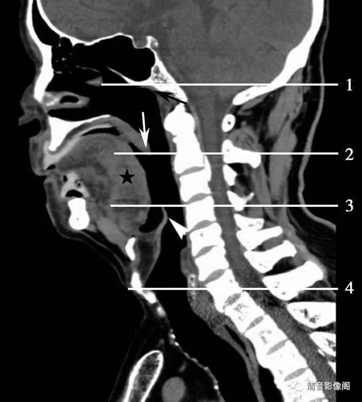 ct入门手把手教你读懂颈部ct