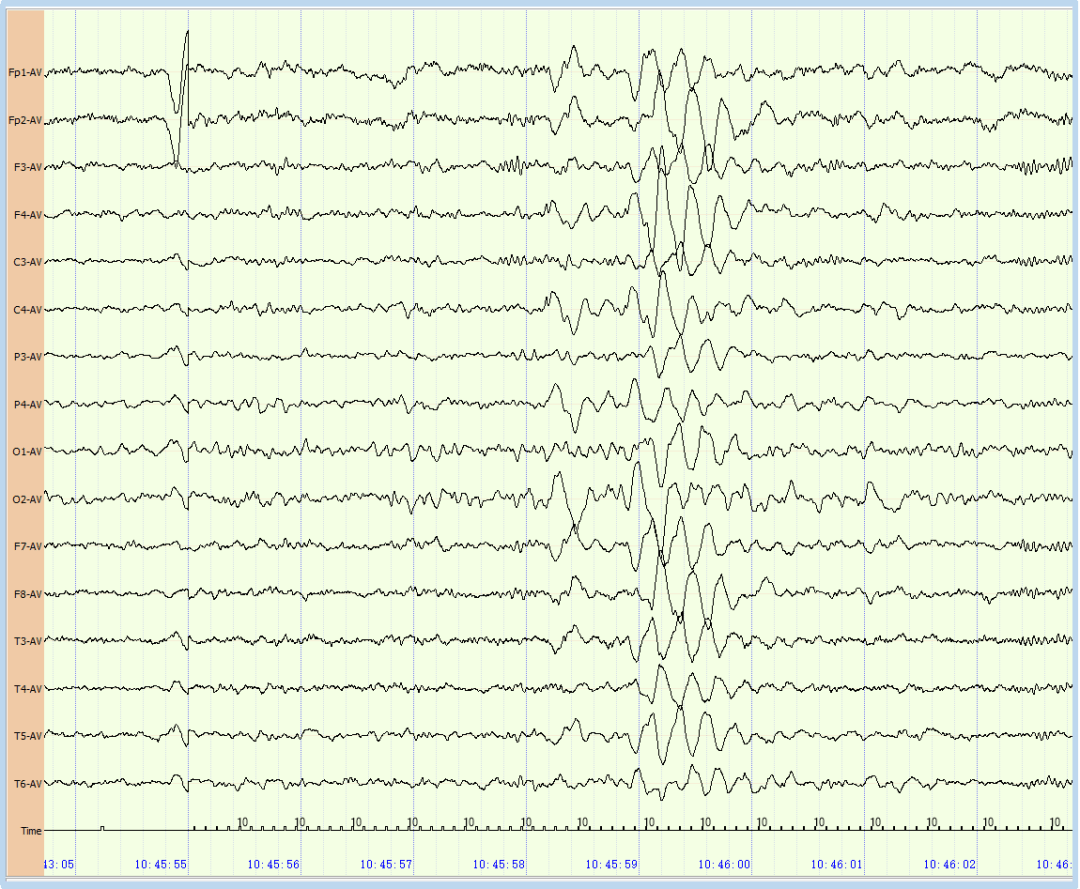 报告显示异常脑电图(阵发性慢波改变),结论属于非特异性改变,轻度异常