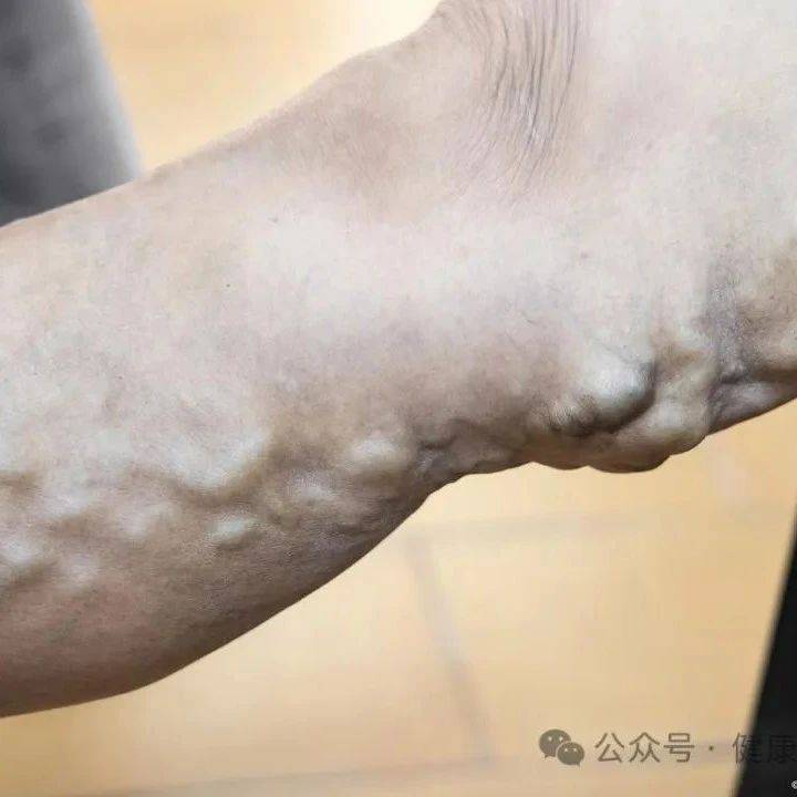 什么是血栓性浅静脉炎？有什么症状？该怎样治疗？_患者_炎症_局部