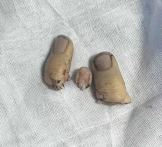 三手指同时离断 赞!再植手术成功