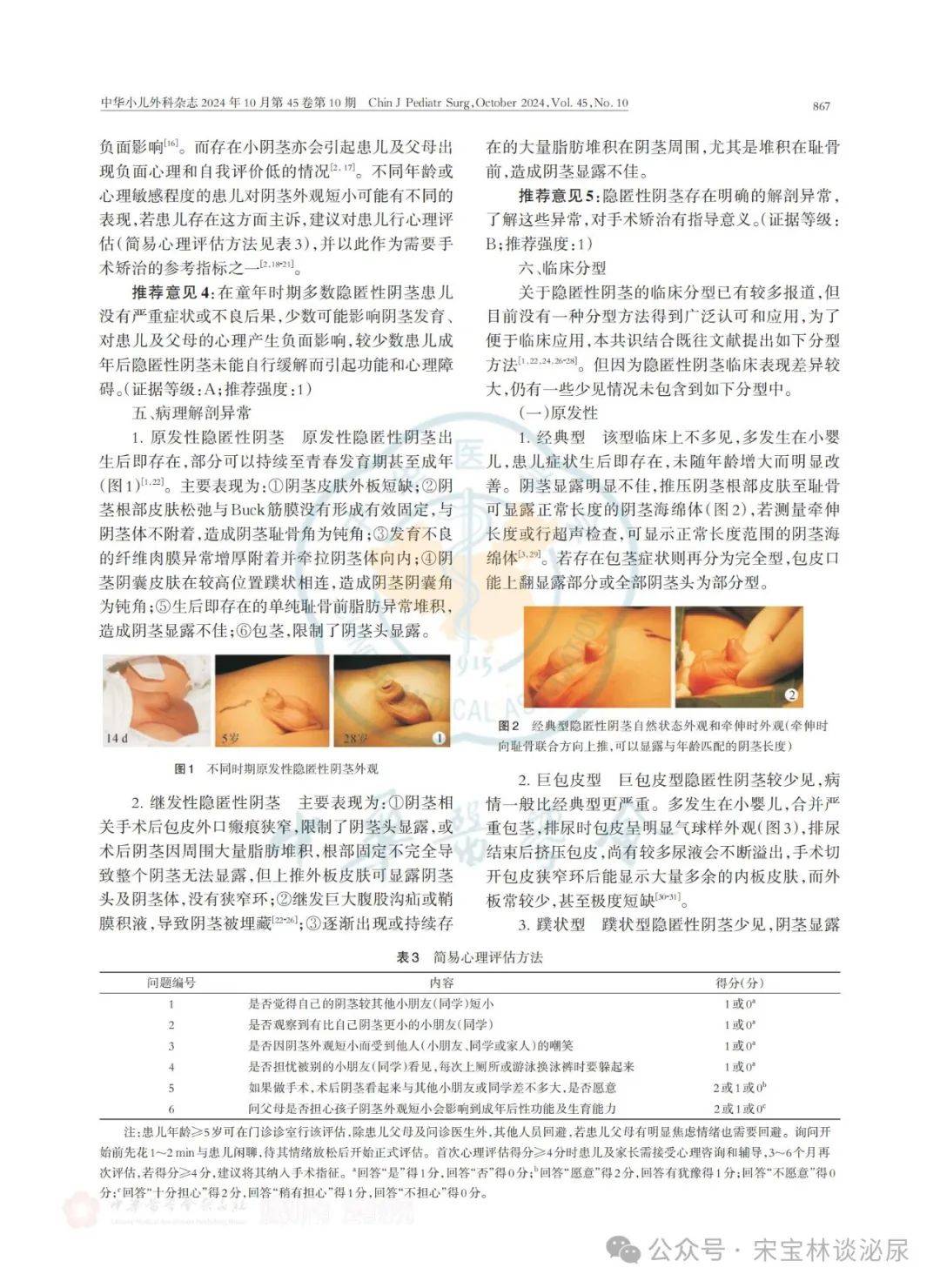 中国小儿隐匿性阴茎临床处理专家共识