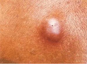 羞羞的地方长了小疙瘩,是得了那种病吗?你想要了解的都在这儿了