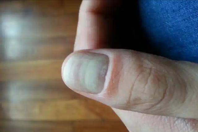 肝硬化早期信号大揭秘，别等严重了才重视！，身体小变化，暗示肝硬化大问题！