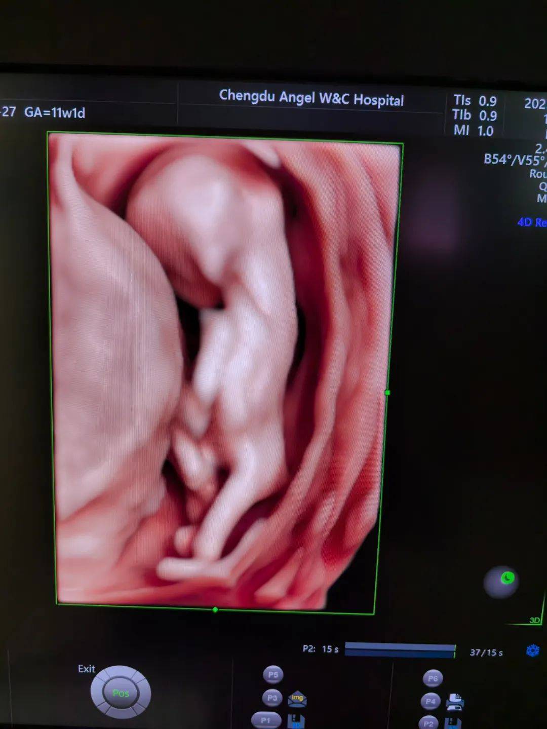 科普 | nt筛查,胎儿排畸第一关,千万别耽误!