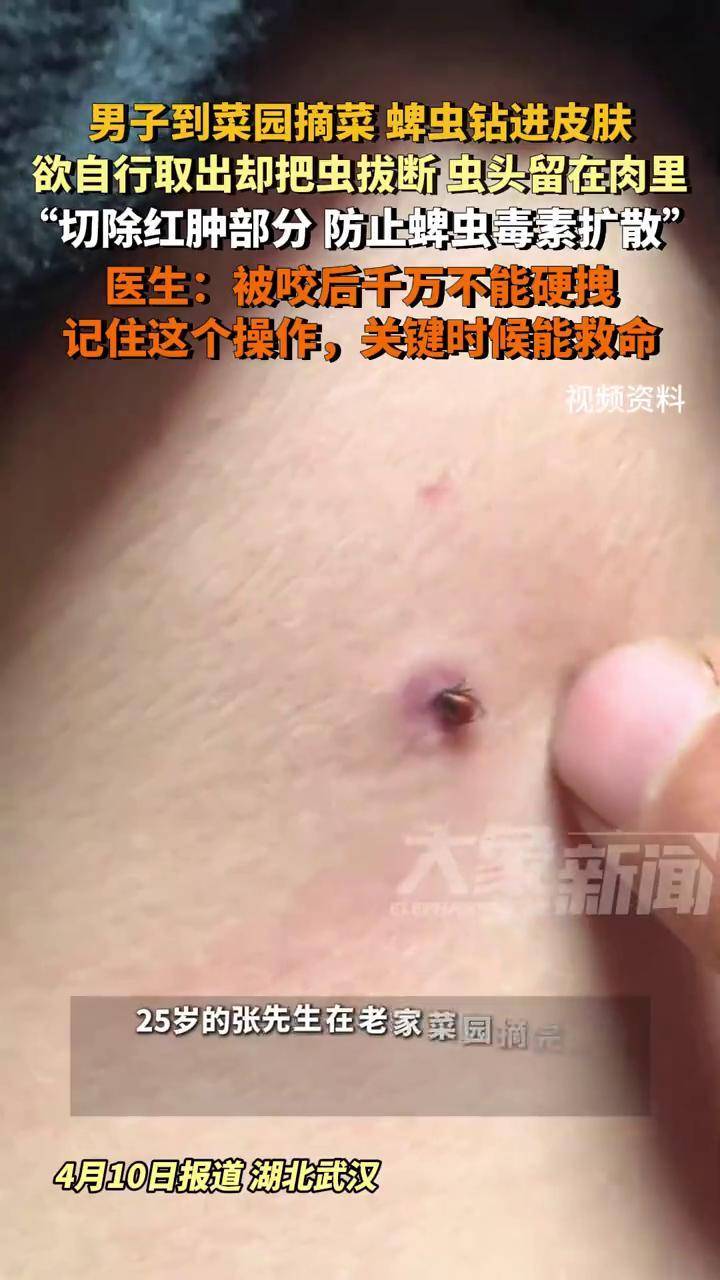 男子到菜园摘菜 蜱虫钻入皮肤,欲自行取出却把虫拔断了