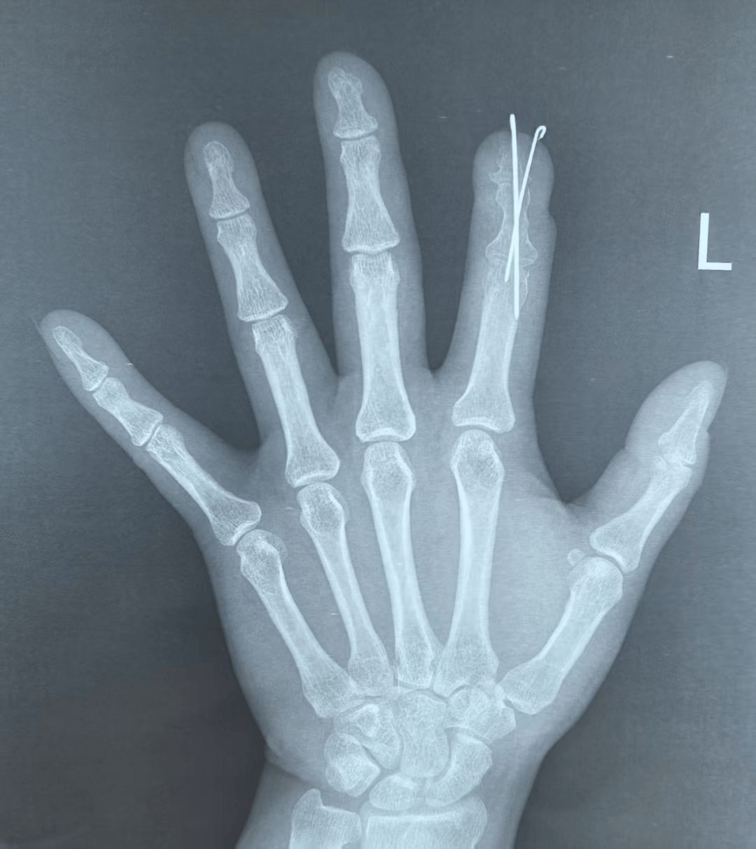 手指缺失十余年 一朝手术满意归!