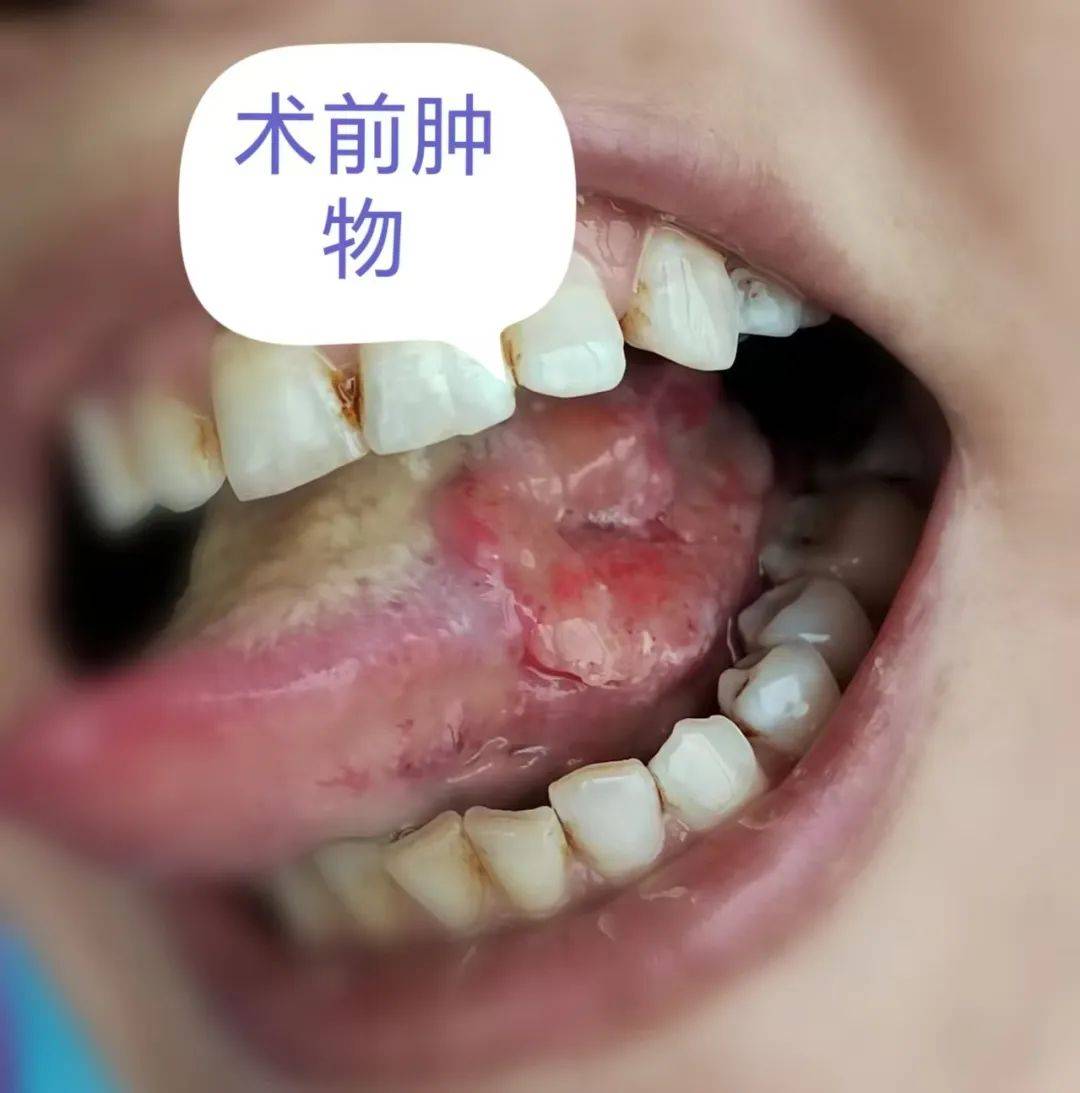 致癌物质持续刺激,最终可能发展为口腔鳞癌,甚至