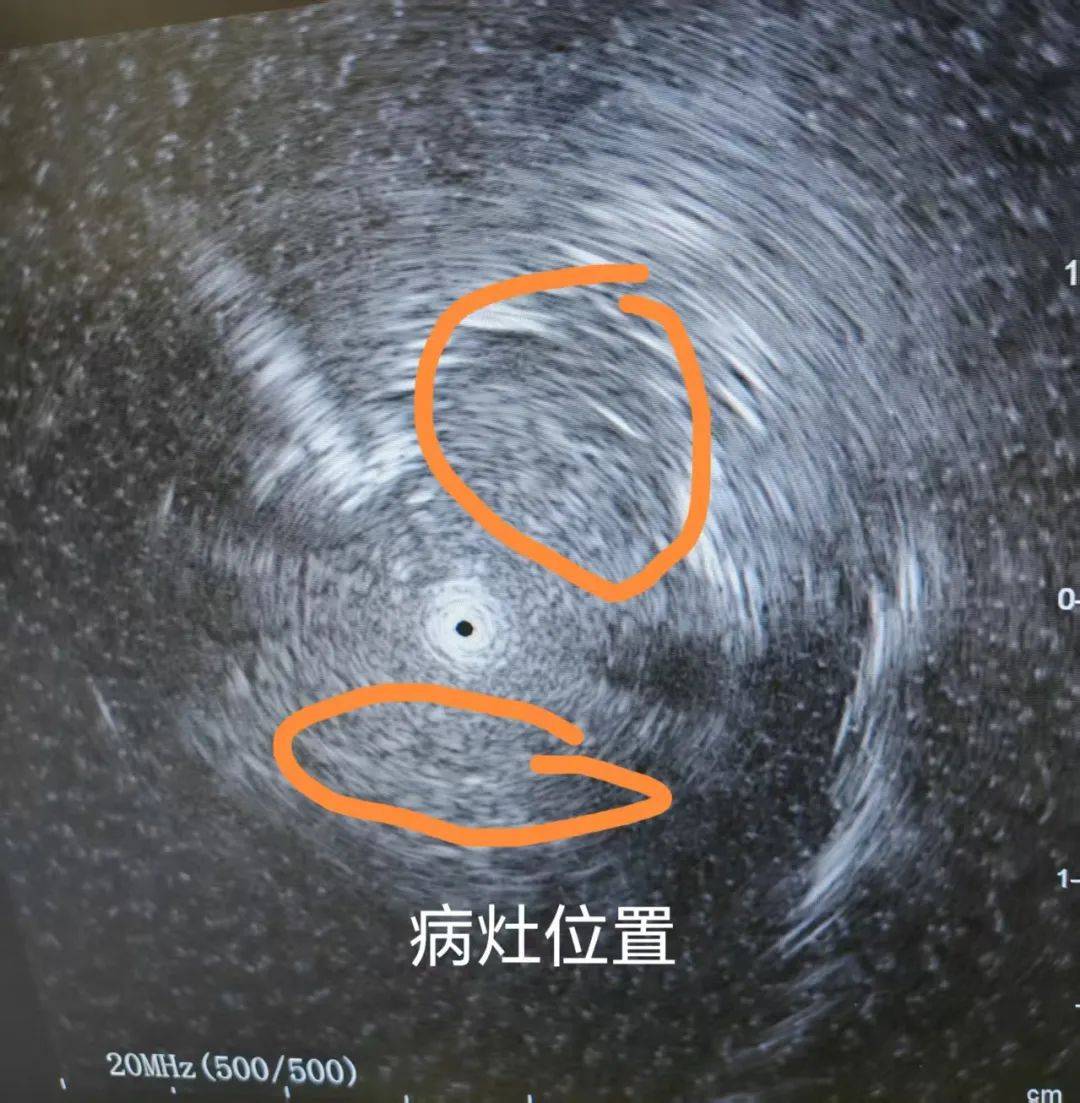 技术突破北京老年医院呼吸内科成功开展首例径向超声引导下经气管镜