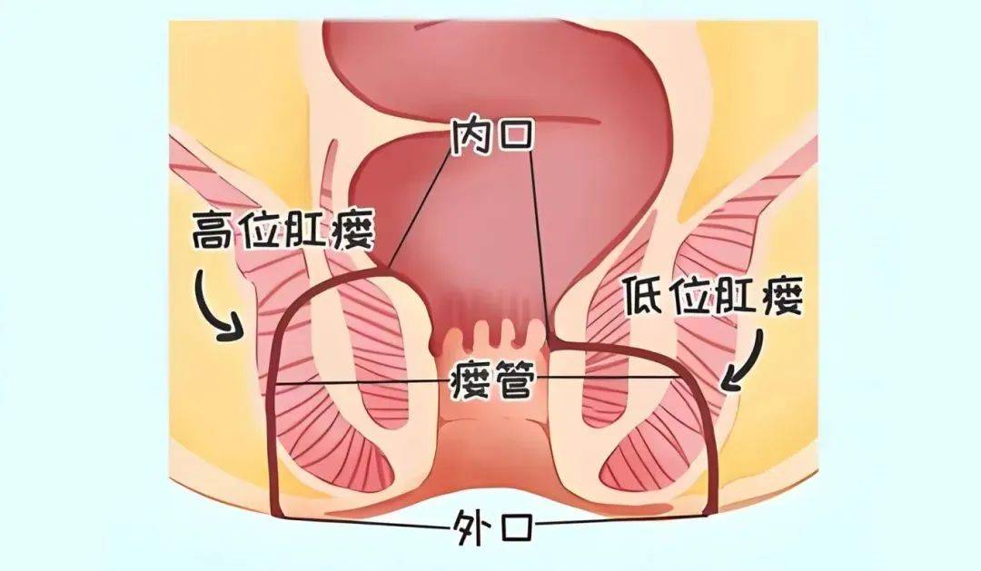 全区首例!余杭二院"高位复杂性肛瘘虚实挂线"技术实现新突破