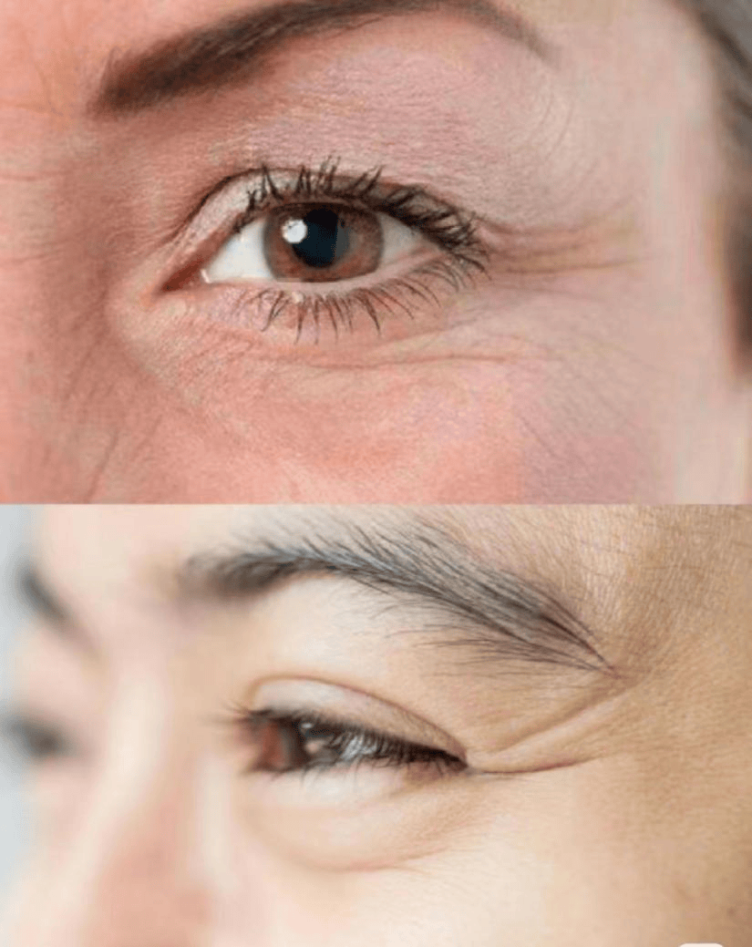 招募丨市一医院招募静态鱼尾纹受试者