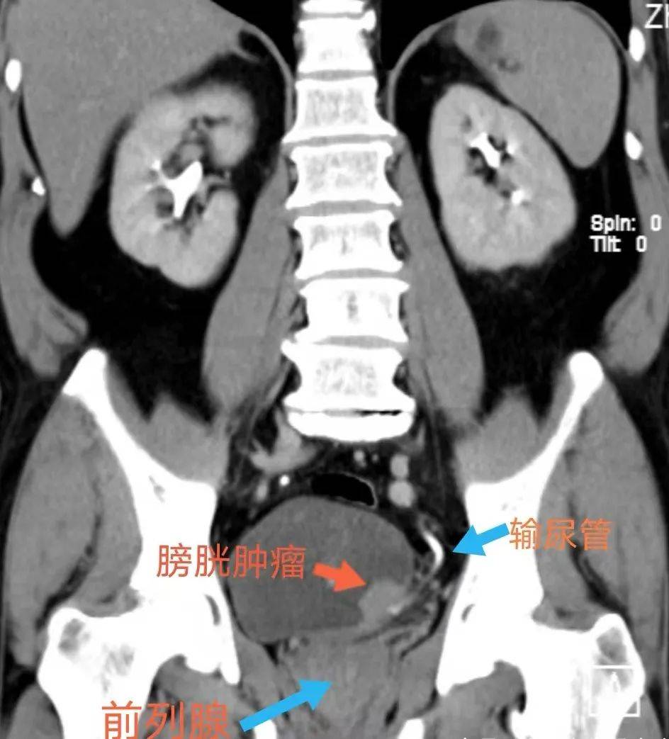 无痛血尿≠小事!破解膀胱癌的"伪装"信号