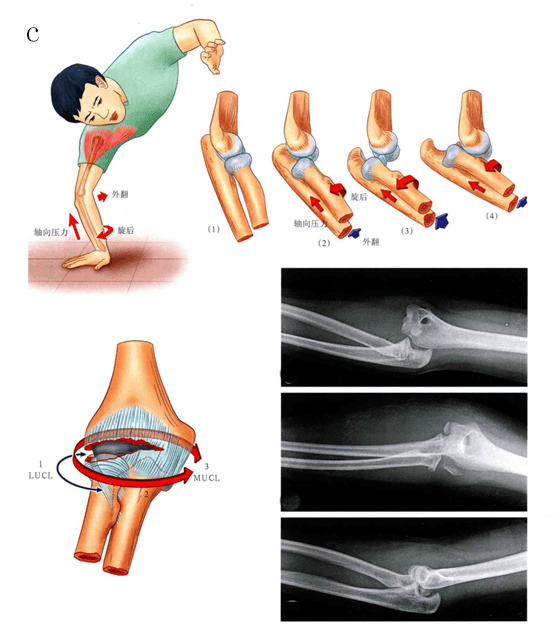 如何应对肘关节"恐怖三联征"?