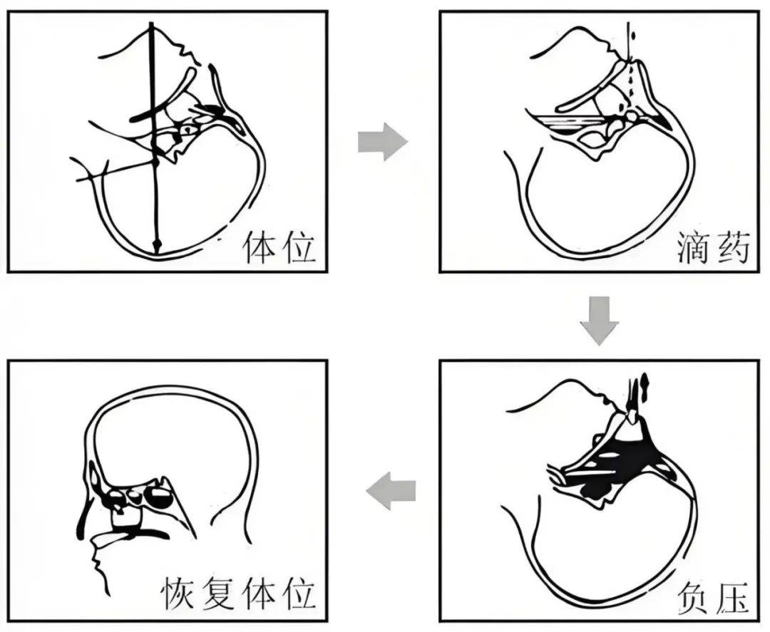 告别鼻塞通畅呼吸我院常规开展鼻负压置换治疗术
