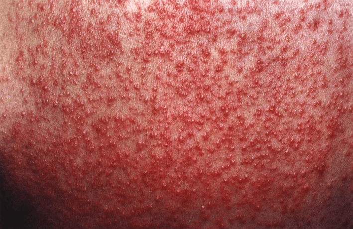的针头大小的密集丘疹或丘疱疹,周围有轻度红晕,皮疹消退后有轻度脱屑