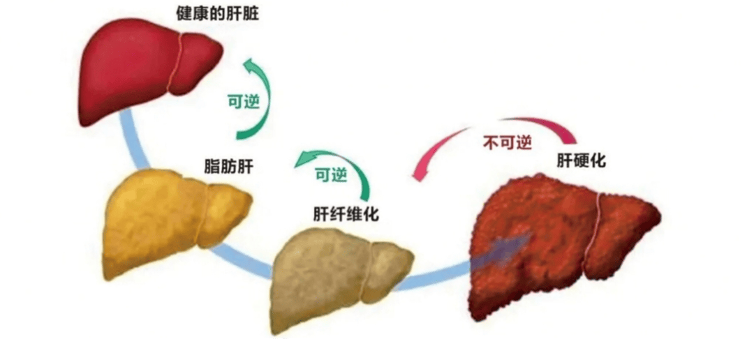 “国际”科学|吃“干净”的生活，三种类型的食物会使脂肪肝活跃
