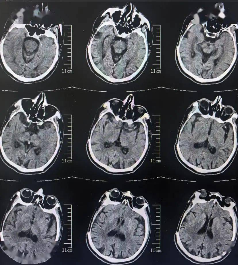 头部ct示排除颅内出血