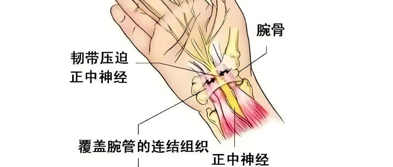 手腕部的“小麻烦”-------腕管综合症_神经_正中_症状