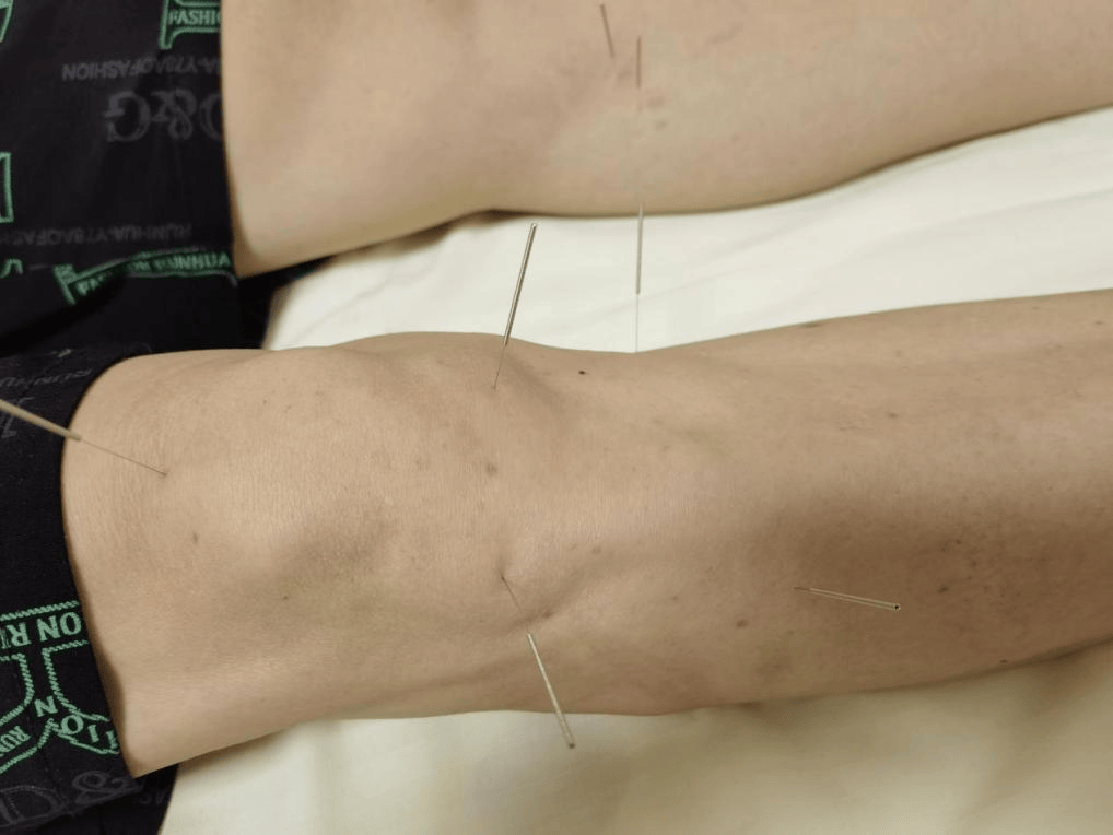 针刺时选用0.4毫米*50毫米一次性针灸针具,选取犊鼻