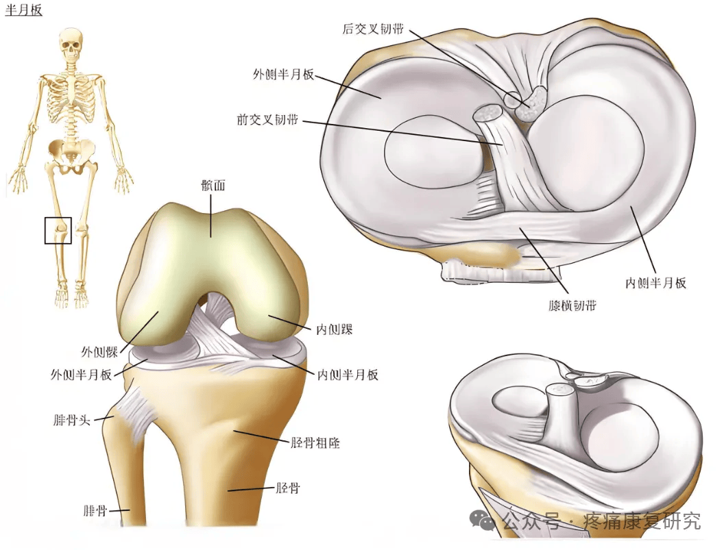 半月板:膝关节里的 "易损件",损伤后难自愈,膝痛者速看