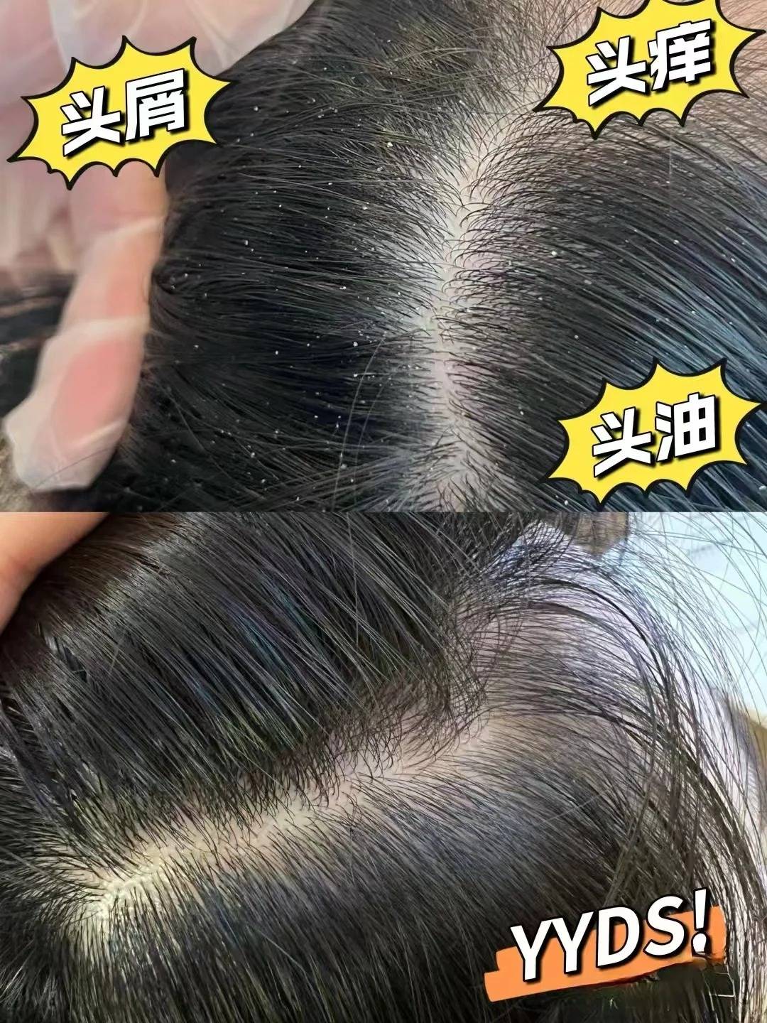 什么洗发水能去屑止痒?解决头屑油腻脱发问题