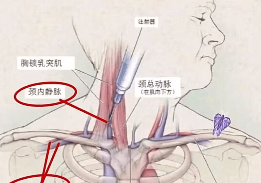 icu为什么会选择深静脉管路