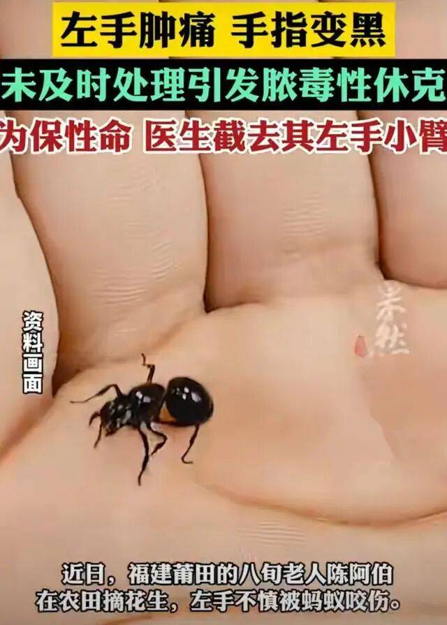 福建老人不慎被蚂蚁咬伤左手,3天后手指肿痛发黑!为保命截肢