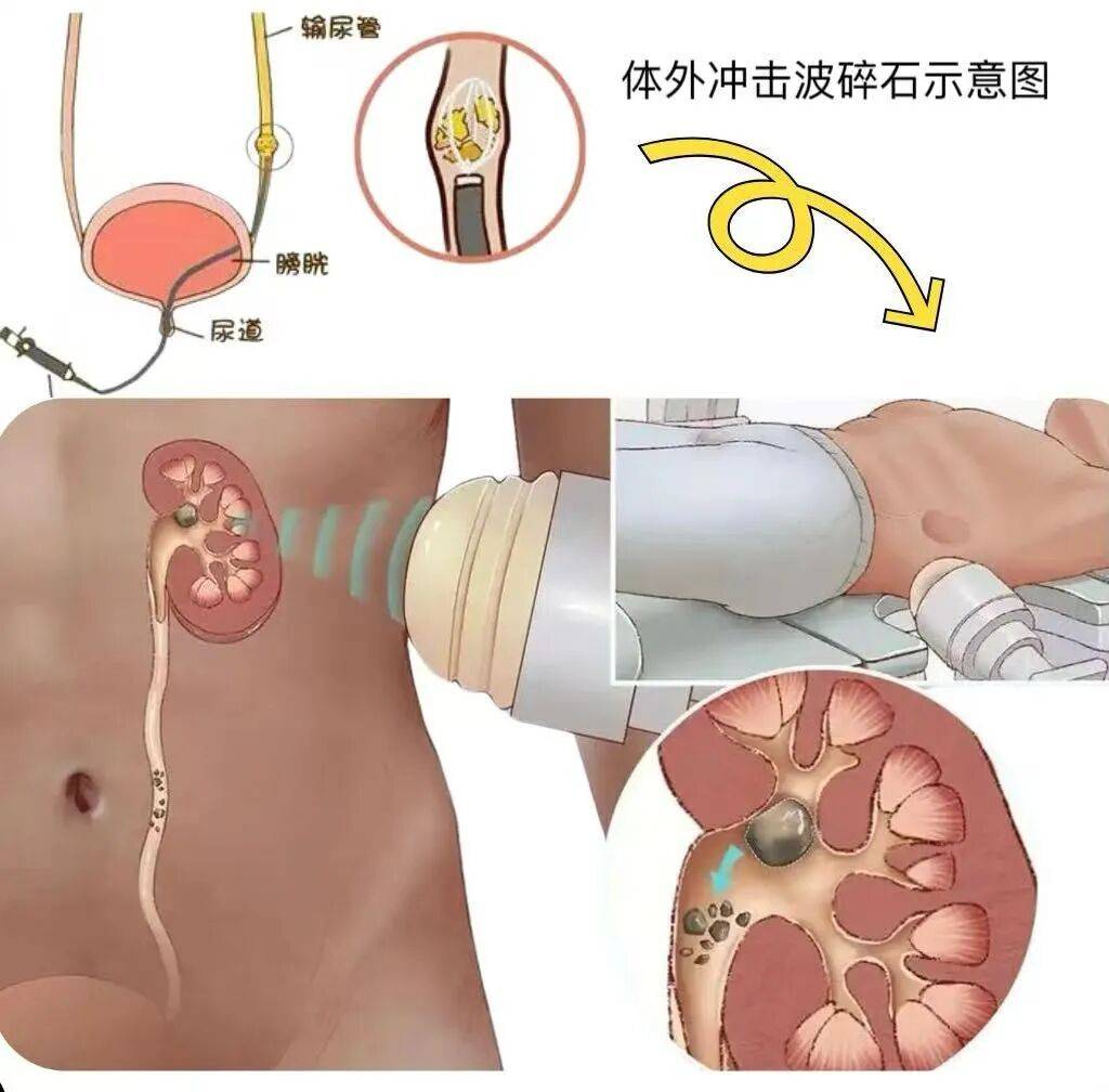 激光碎石:专啃"硬骨头"要是结石是"大块头"